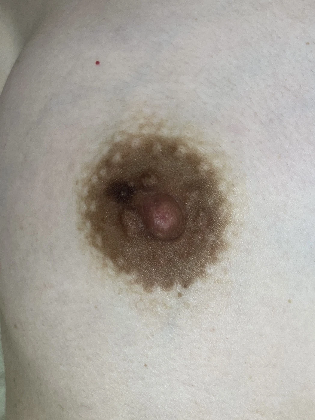 乳首の施術前（差し替え用仮画像）